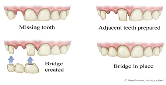 Dental-Bridge-NorthShore