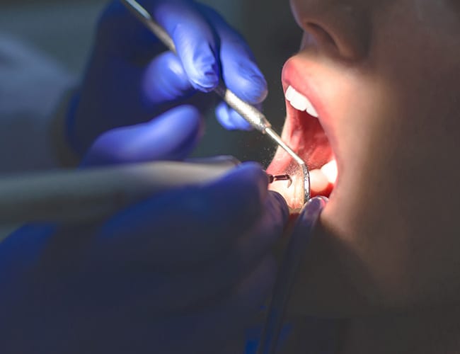 Dental-Sealants-&-Fluoride-NorthShore