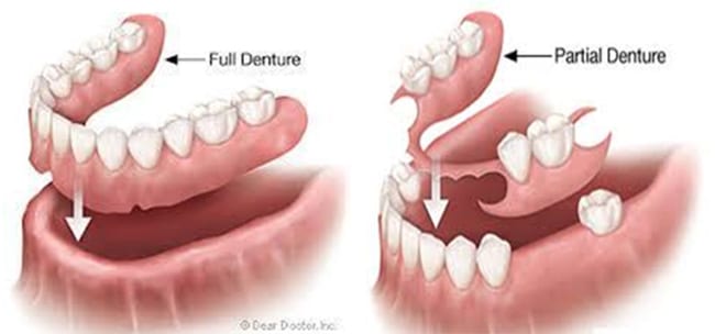 Full-and-Partial-Dentures-NorthShore