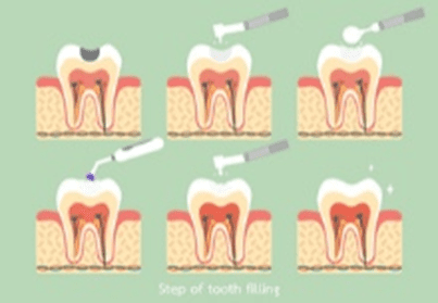 Tooth filling steps