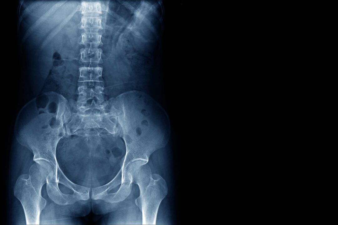 A x - ray image of a hip and pelvis.