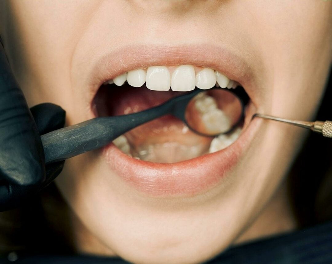 A woman is getting her teeth inspected at the dentist